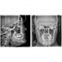 Vatech PaX-i 3D SC 10x8.5 - томограф с цефалостатом